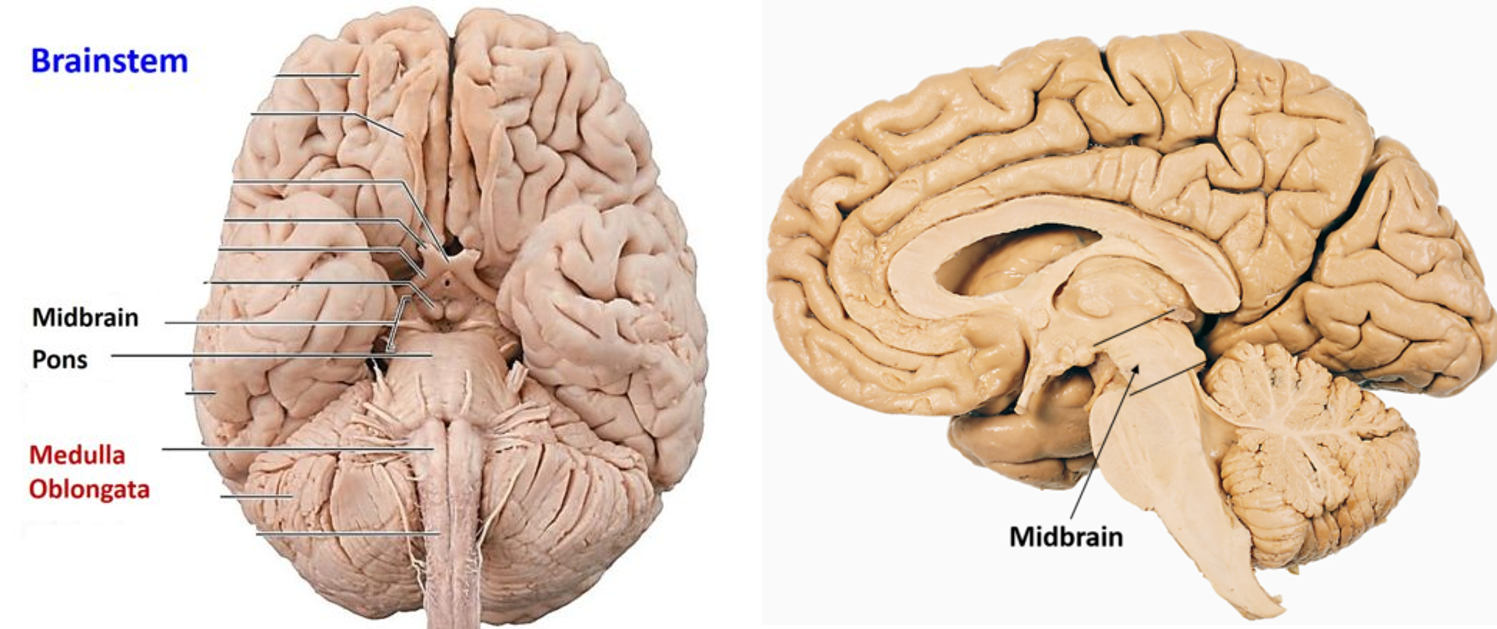 Midbrain Anatomy , external and internal features, arterial supply and  lesions , Anatomy QA