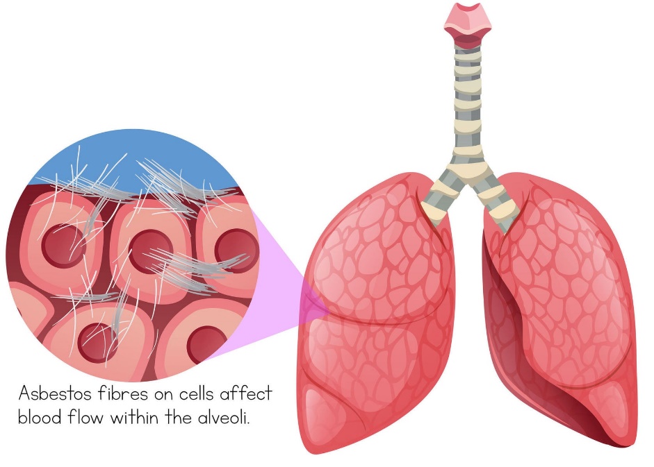 What does asbestos do to you? | Affects of exposure and who is at risk