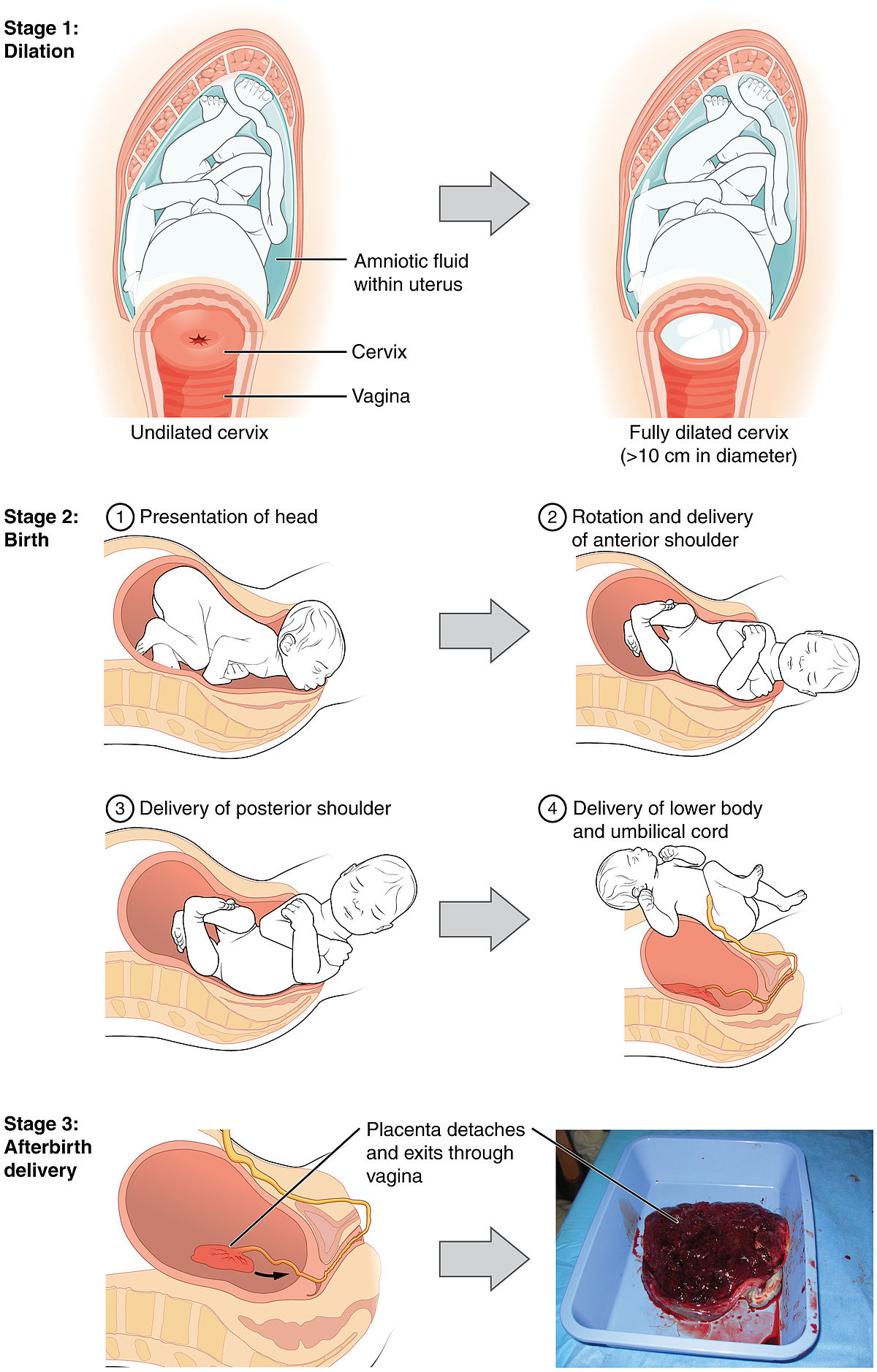 Vaginal delivery - Wikipedia