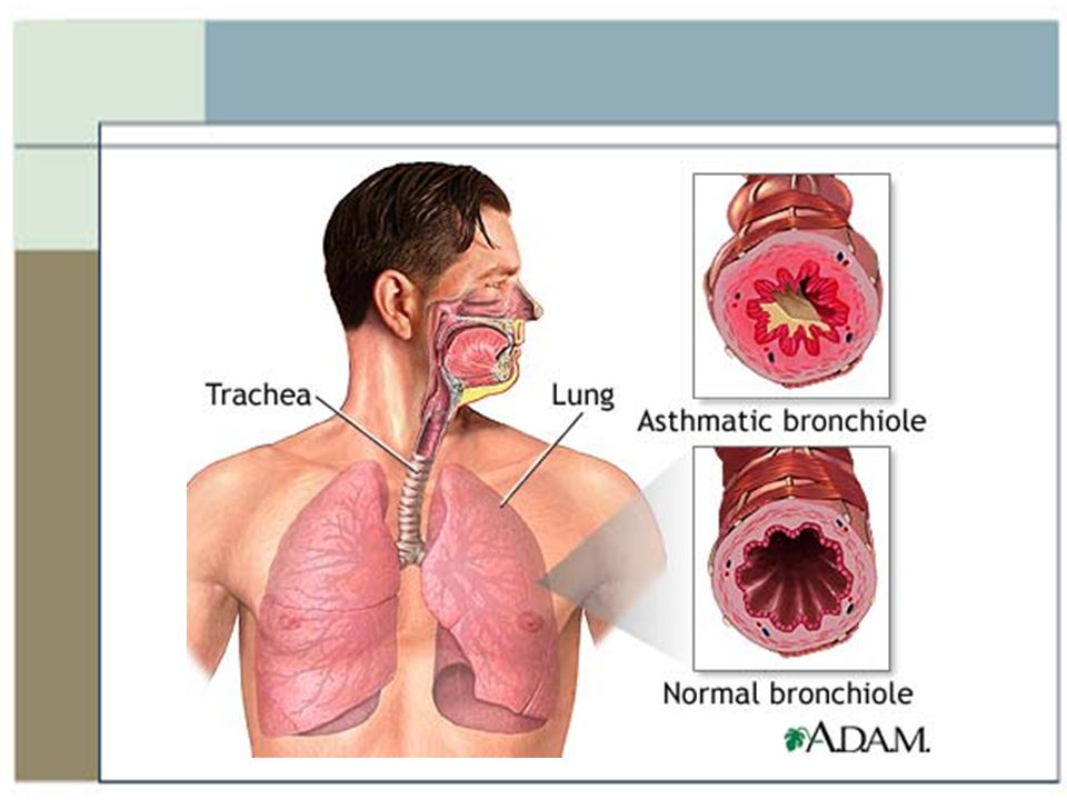 Asthma and Work-related Asthma Developed by: Dana Hughes, RN, PhD Miners  Hospital, University of Utah Libbey M. Chuy, MPH Asthma Program, Utah  Department. - ppt download