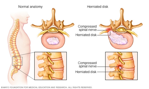 Herniated disk - Symptoms and causes - Mayo Clinic