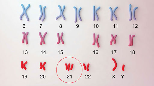 Image result for down syndrome chromosome