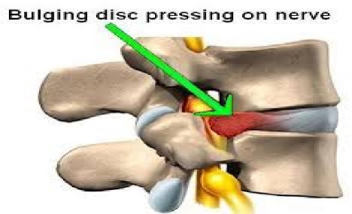 Slipped Discs | Chiropractors in Eastbourne