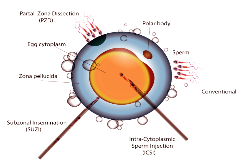 Best ICSI Treatment Centre in Bathinda, Punjab, India