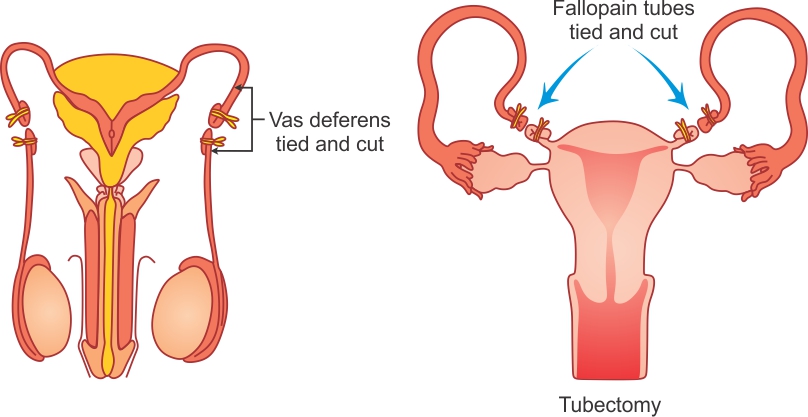 Describe surgical method of birth control - Biology - TopperLearning.com | ksvuwxqq