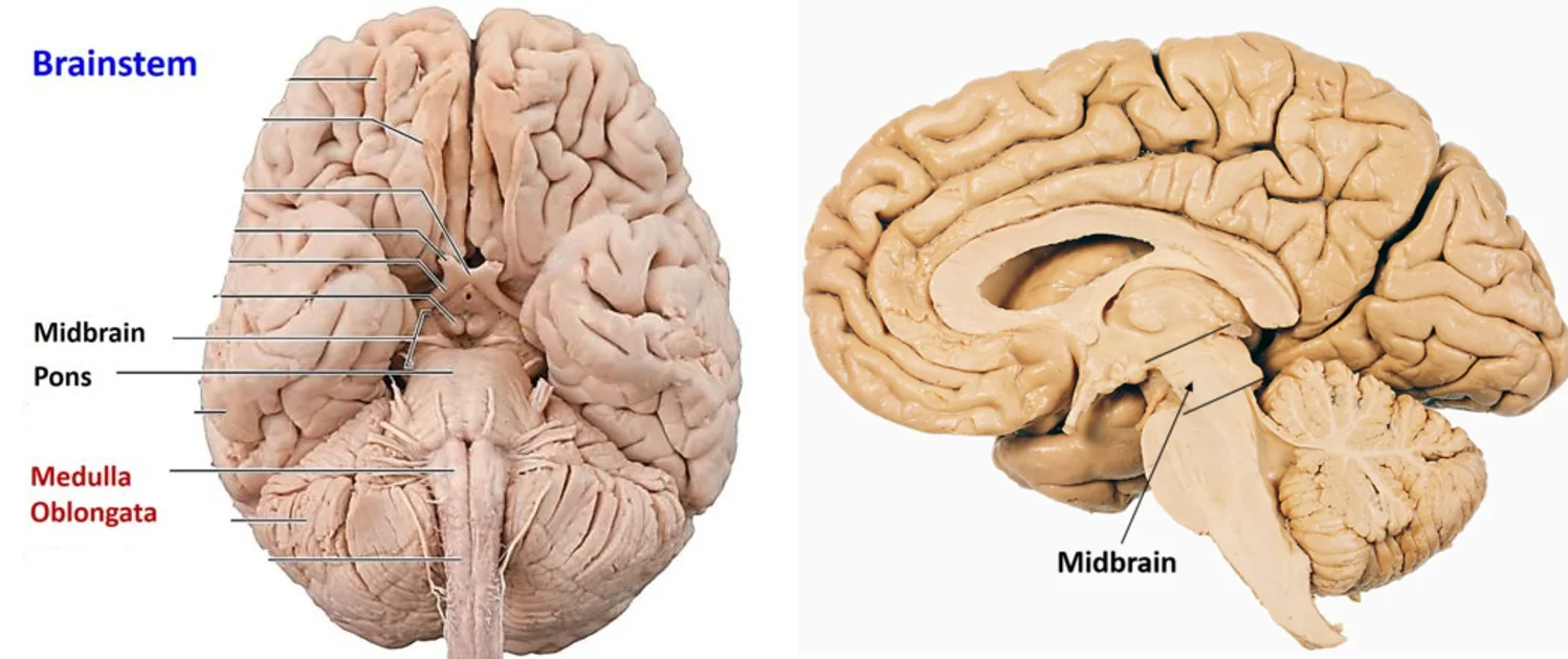 Midbrain Anatomy , external and internal features, arterial supply and  lesions , Anatomy QA