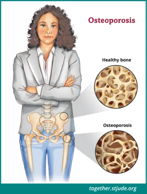 Bone Loss and Osteoporosis in Childhood Cancer Survivors - Together