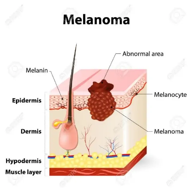 Melanoma Or Skin Cancer. This Rare Type Of Skin Cancer Originates.. Royalty  Free Cliparts, Vectors, And Stock Illustration. Image 55495723.