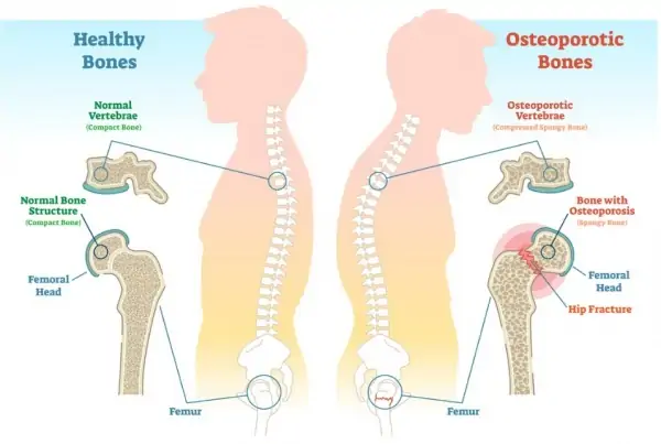 Osteoporosis Overview - Could it affect you?
